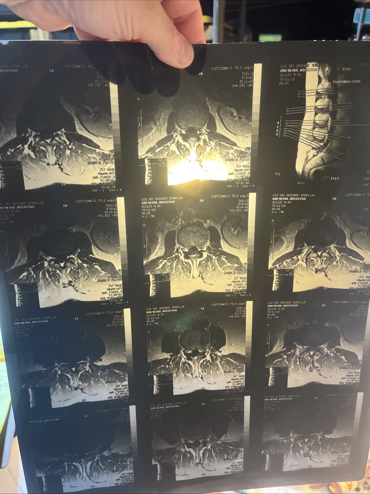 MRI CT Spine Scans X-Rays Medical Back Prop Halloween Lot of 24 Silver Recovery