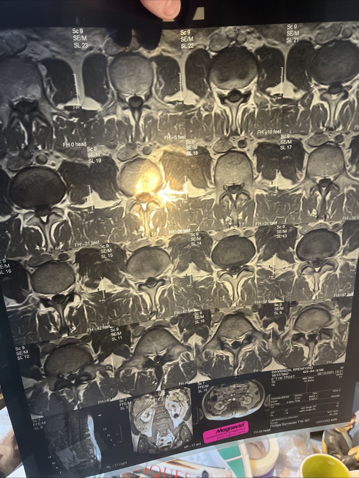 MRI CT Spine Scans X-Rays Medical Back Prop Halloween Lot of 24 Silver Recovery