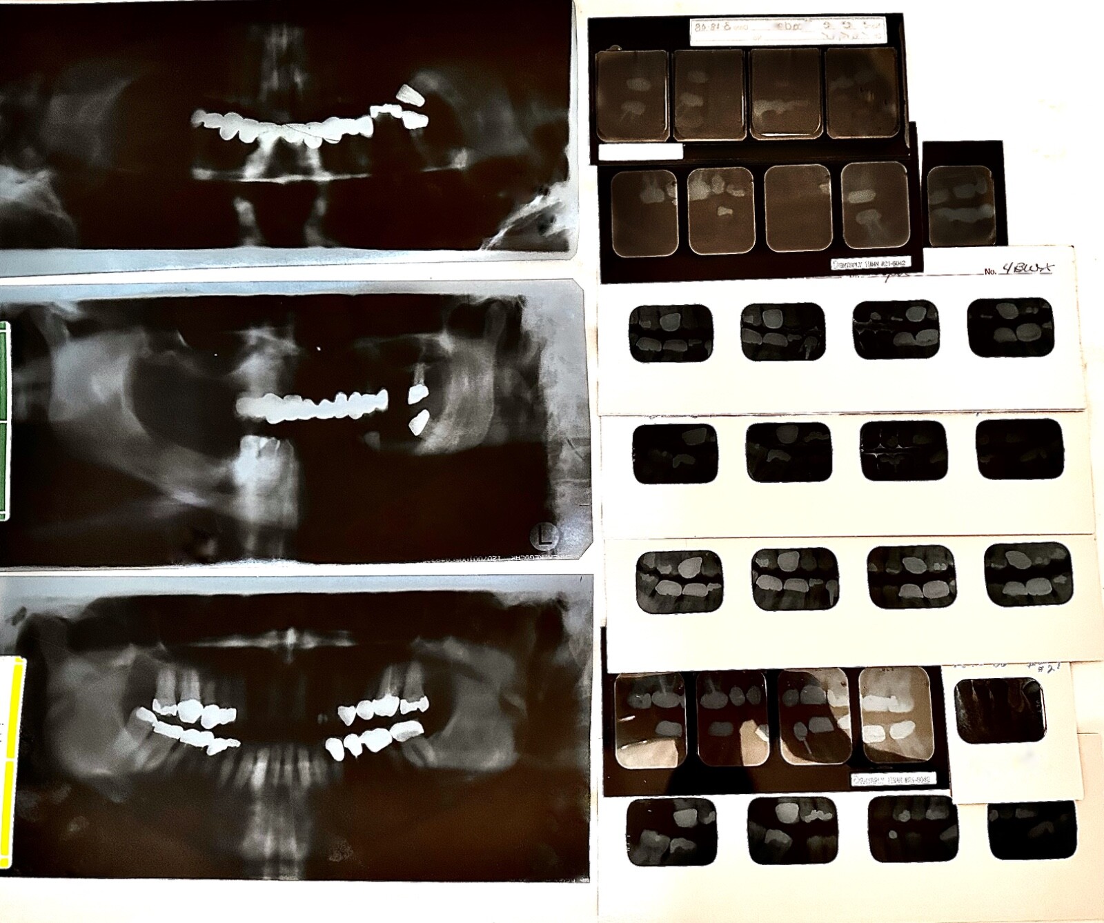 Dental X-Rays Huge Lot Oddities Vintage Teeth Cavities Tooth Jaw 30 + Films