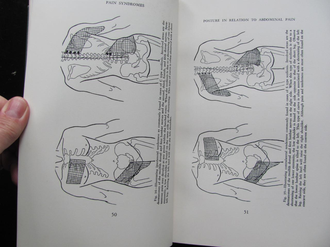 Pain Syndromes Judovich & Bates 1949 3rd Ed 181 Illustrations Medical Book
